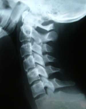 Cervical_Spine_Xray.jpg